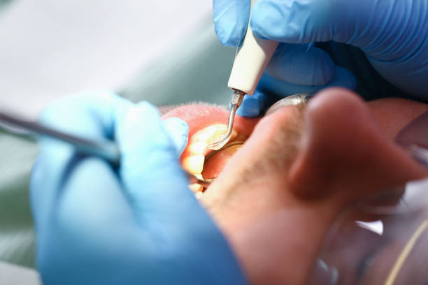 Best Emergency Dentist for Knocked-Out Tooth in Upland, IN