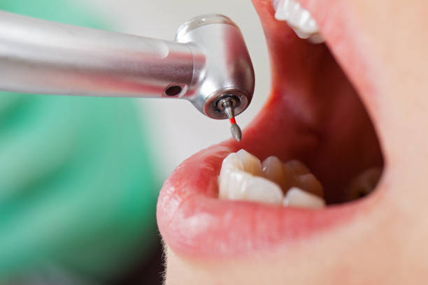 Best Emergency Dentist for Lost Fillings or Crowns in Upland, IN
